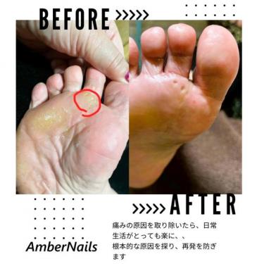 【Before/After】歩くたびに痛む「魚の目」を、根本から丁寧にケア